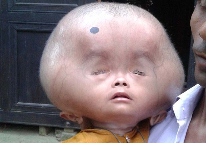 শিশুটির মাথার ওজন ৯ কেজি!