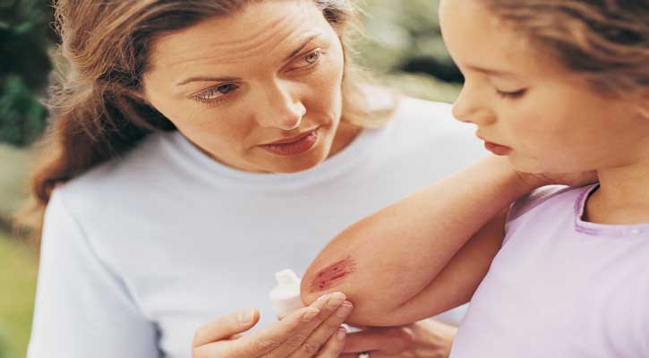 কাটাছেঁড়া উপশমে ৫ প্রাকৃতিক অ্যান্টিসেপটিক