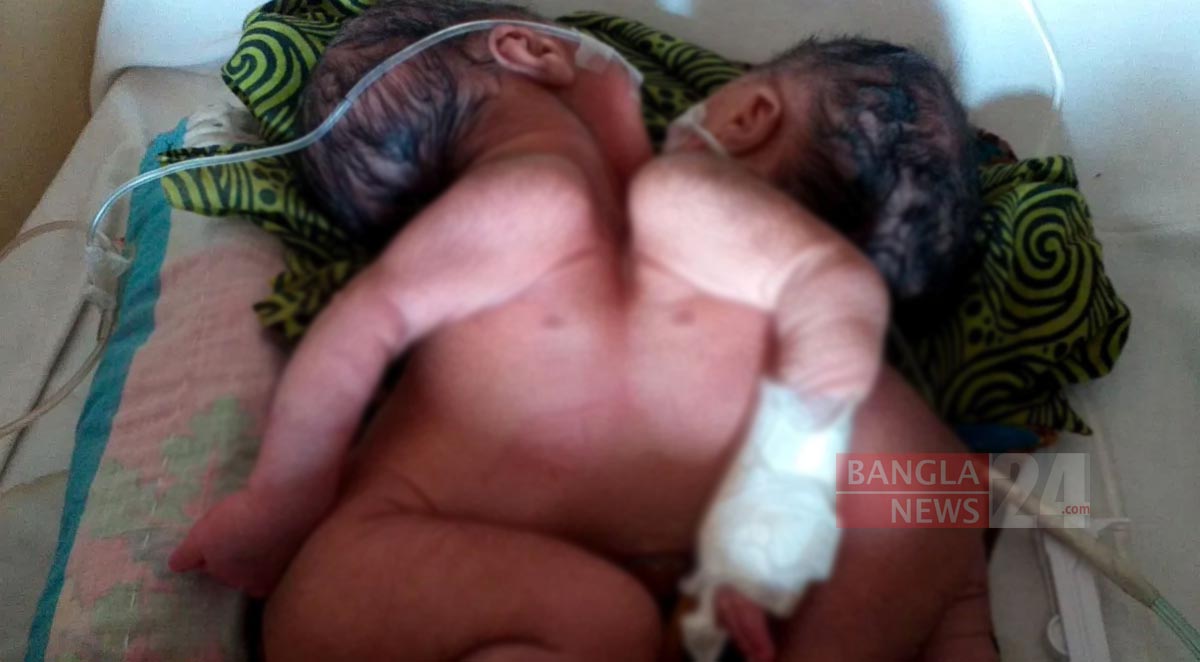 মৌলভীবাজারে ব্যতিক্রমী জোড়া যমজ শিশুর জন্ম