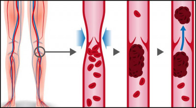 সমস্যার নাম থ্রম্বোসিস